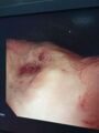 пациент 1 (3)